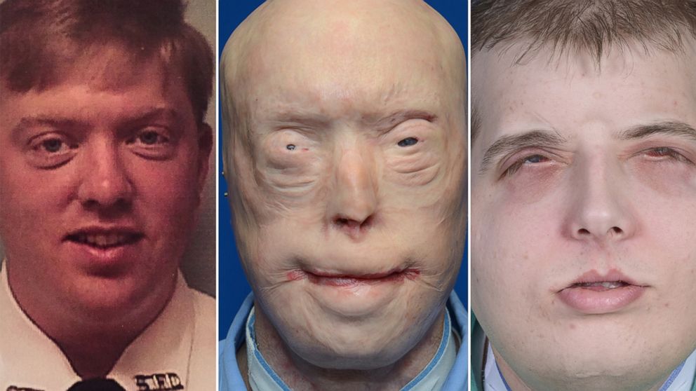 PHOTO: Pat Hardison is shown here before the 2001 fire (left), then before his face transplant surgery (center) and what he looks like today after surgery (right).