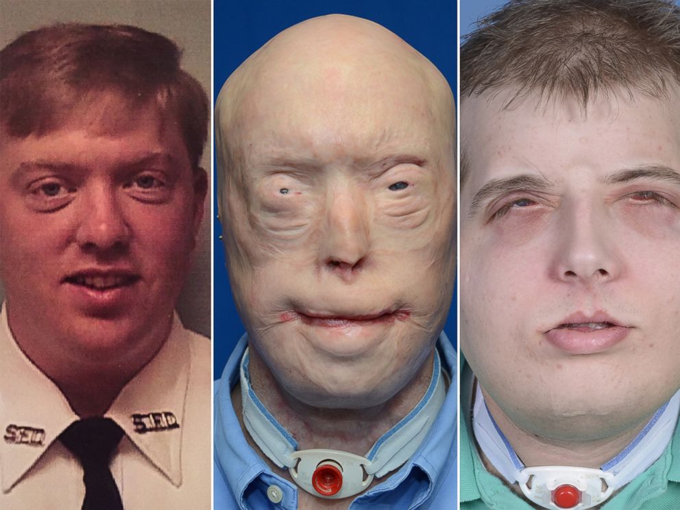 PHOTO: Pat Hardison is shown here before the 2001 fire (left), then before his face transplant surgery (center) and what he looks like today after surgery (right).