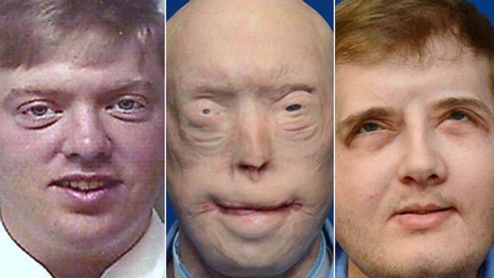 Meet the First African-American Face Transplant Recipient