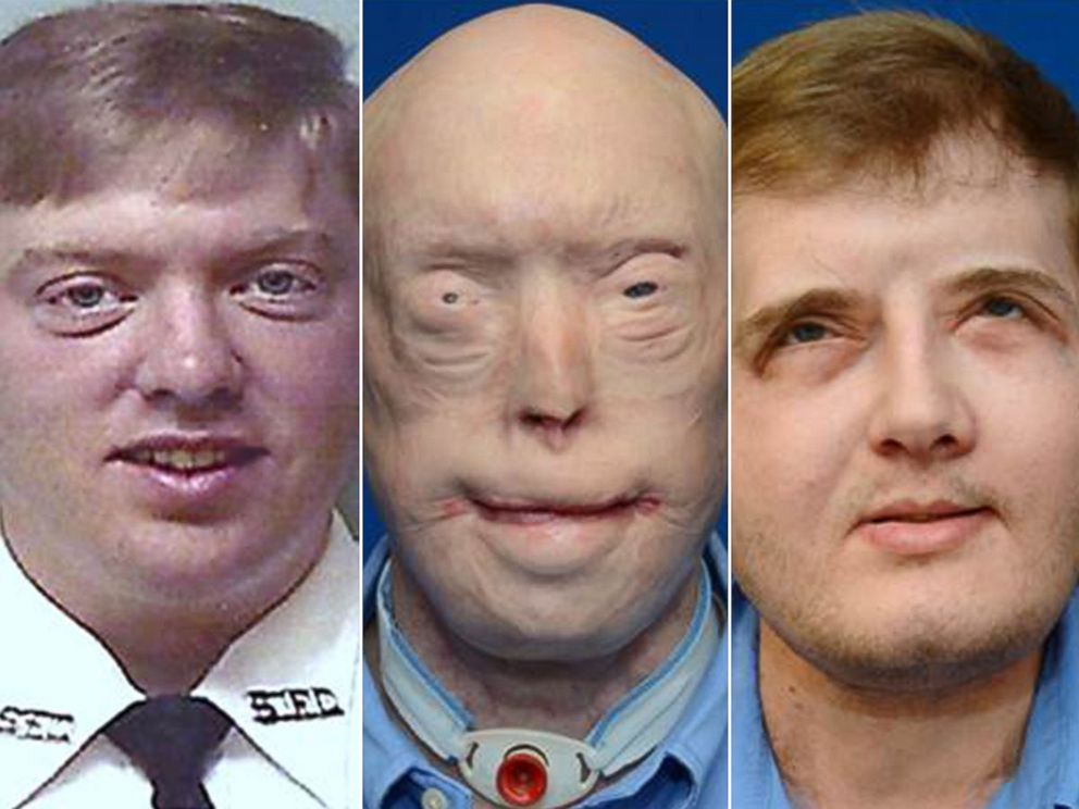 PHOTO: Pat Hardison is shown here before the 2001 fire (left), then before his face transplant surgery (center) and what he looks like today after surgery in August 2016 (right).