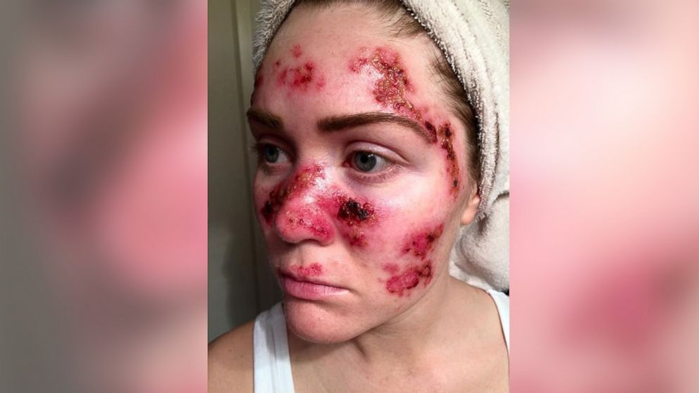 PHOTO: Tawny Willoughby posted this photo to  her Facebook page on April 25, 2015 to draw attention to the risks of skin cancer. 