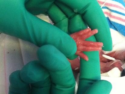 Hospitals Tiniest Preemie Home After Four Months in NICU