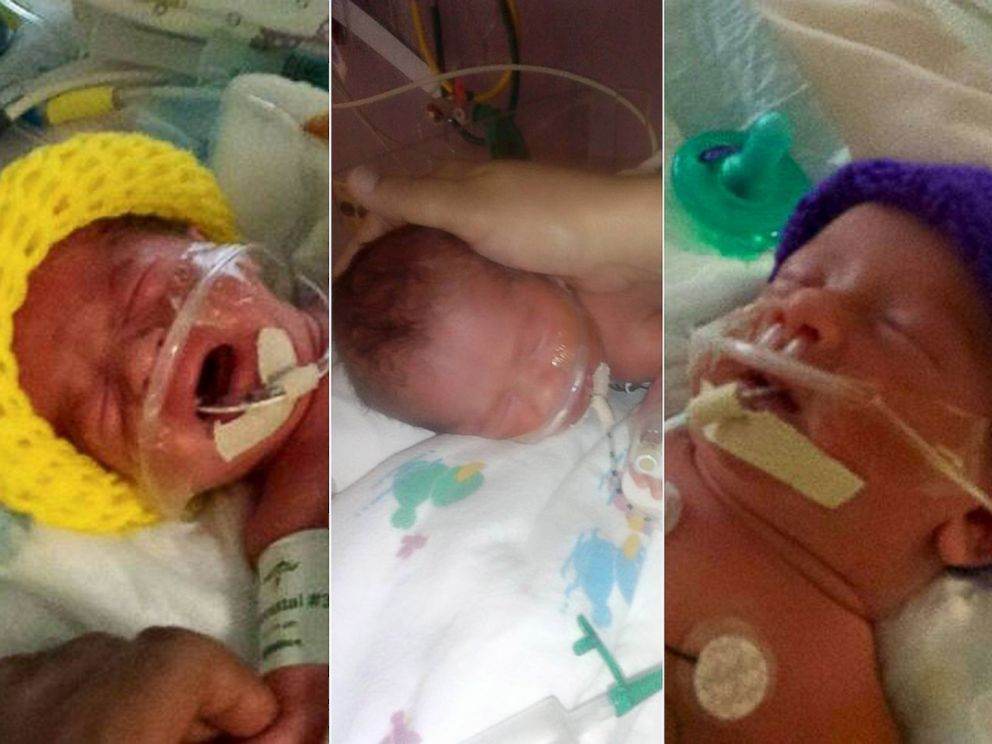 PHOTO: Rare identical triplets were born in Texas, including two conjoined at the pelvis. The babies are named Catalina Montserrat, Ximena Jackeline and Scarlett Juliet.