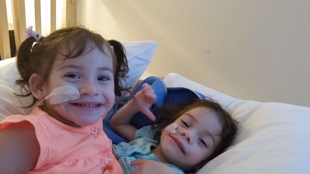 Formerly conjoined twins Eva and Erika Sandoval are seen here before their separation surgery.