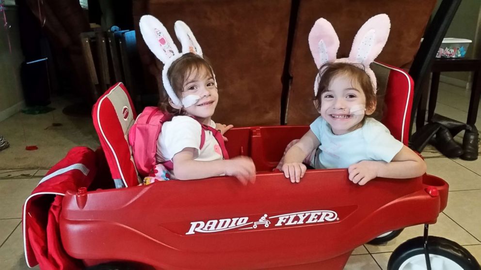 Formerly conjoined twins Eva and Erika Sandoval are seen here after their separation surgery.