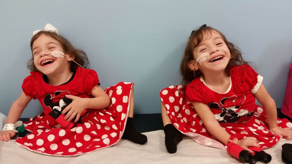Formerly conjoined twins Eva and Erika Sandoval are seen here after their separation surgery.