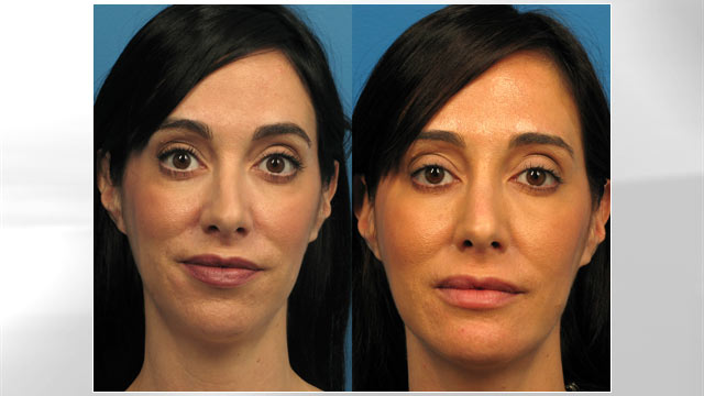 Botched Plastic Surgery? See Azul Plastic Surgery Revisions