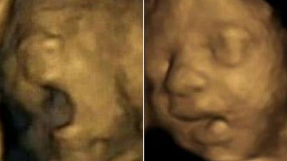 PHOTO: Ultrasound images of a fetus show a yawn compared to simple mouth opening at 27.5 weeks gestation.
