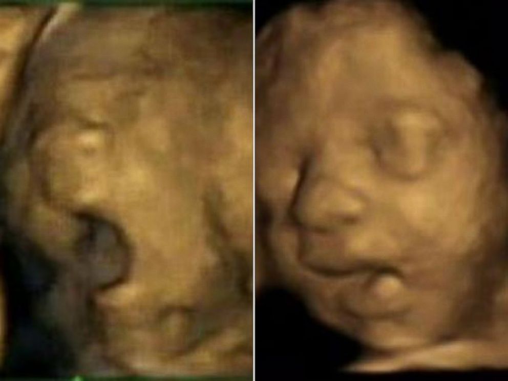 PHOTO: Ultrasound images of a fetus show a yawn compared to simple mouth opening at 27.5 weeks gestation.