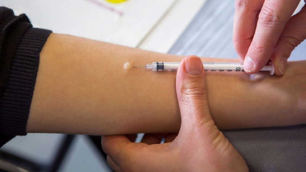 PHOTO: A nurse performs an intradermal injection of the Mantoux PPD skin test on a person's forearm, March 31, 2015, in London