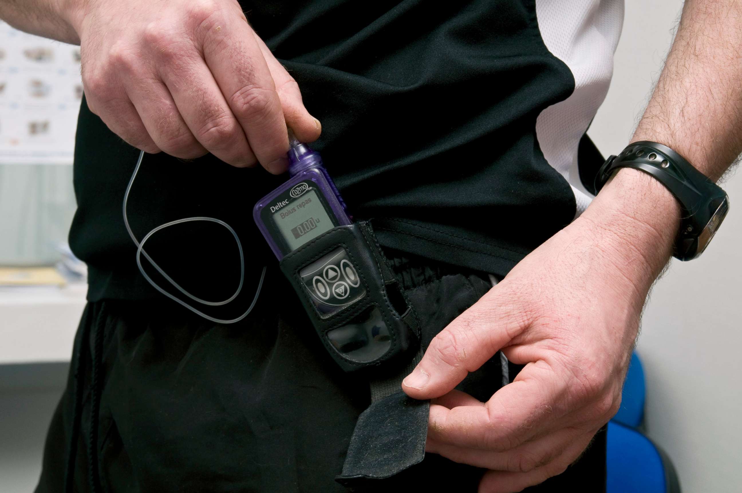 PHOTO: An external insulin pump is carried by a patient with Type 1 diabetes.