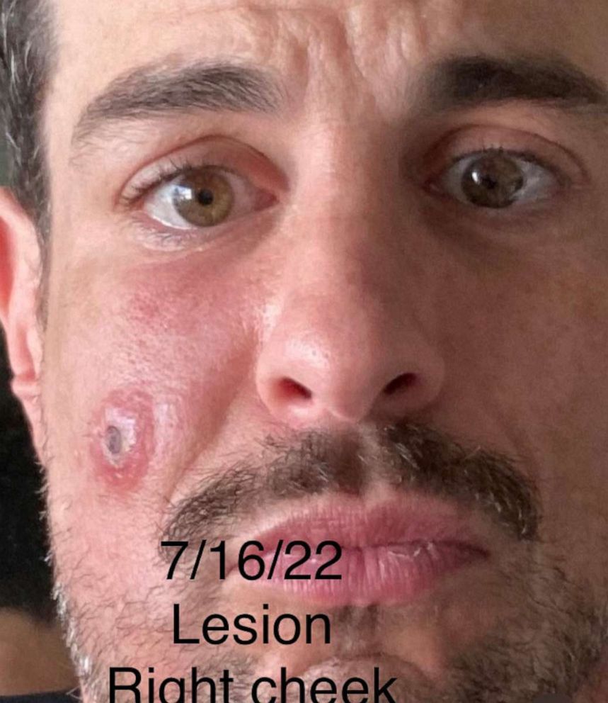 PHOTO: Jeffrey Todd shows his lesion worsening before it scabs over, July 16, 2022. 