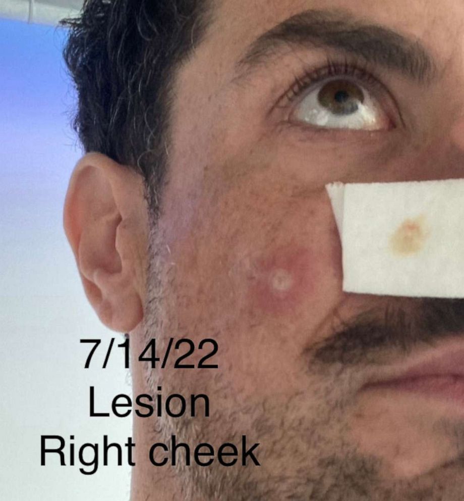 PHOTO: Jeffrey Todd shows the progression of his lesion, July 14, 2022.