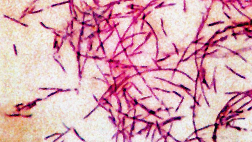 5 diagnosed with Legionnaires’ disease in New Hampshire, health officials say