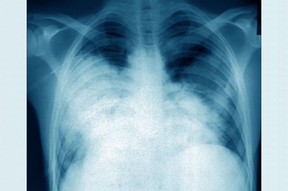 PHOTO: Acute bilateral pneumonia (Legionnaires' disease caused by Legionella pneumophila), seen on a frontal chest X-ray.