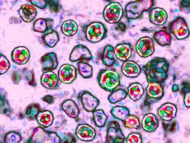 Another measles-related death reported in Pennsylvania as outbreak grows