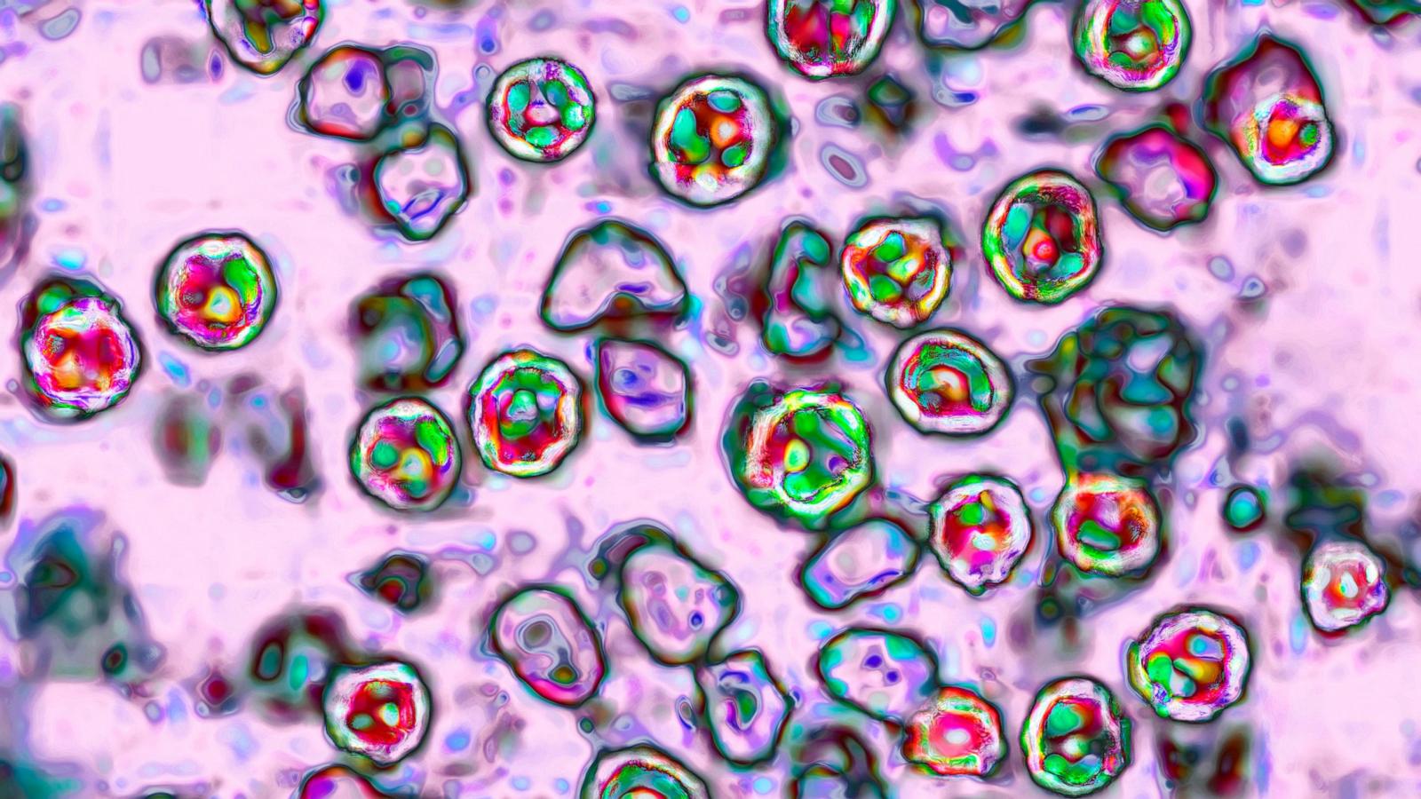 Measles-related deaths in Pennsylvania rise to 4, health officials say
