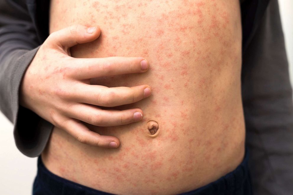 PHOTO: In this undated file photo, a child is shown with red rash spots from measles.