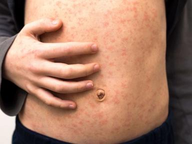 Unvaccinated New Mexico resident tests positive for measles after dying