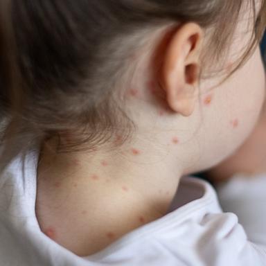 Measles was eliminated in 2000, so many new doctors may not have the experience to know what it looks like when an outbreak occurs. 