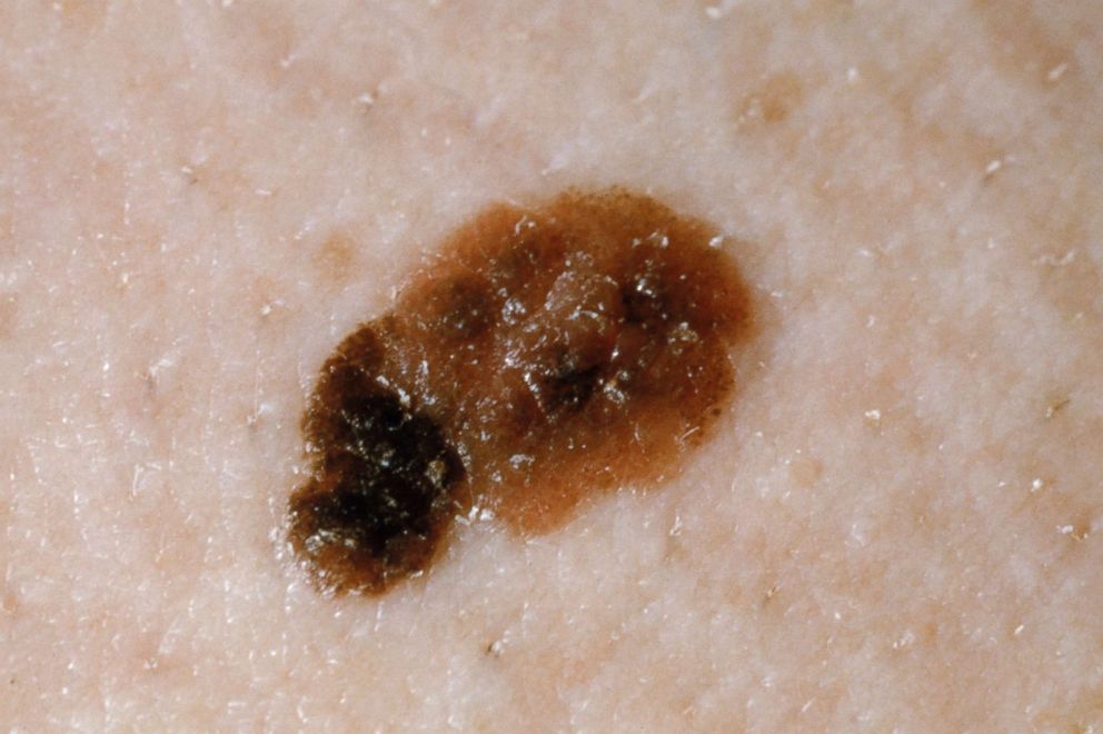 PHOTO: Superficial spreading malignant melanoma is pictured in this undated stock photo.