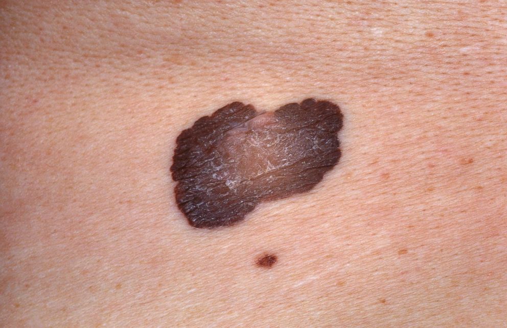 PHOTO: Malignant melanoma tumor of melanocytes in skin is pictured in this undated stock photo.
