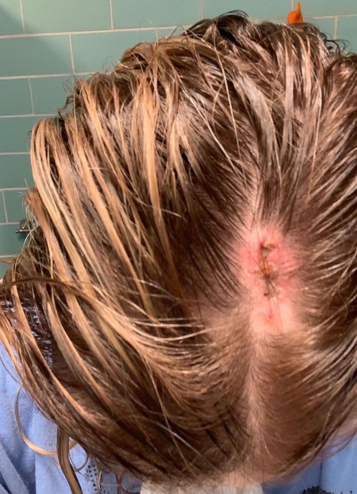 PHOTO: Caitlin Jones, a 30-year-old physician's assistant in Ohio, noticed a suspicious-looking mole on her scalp. Like many patients, she was concerned about going for an in-person appointment.
