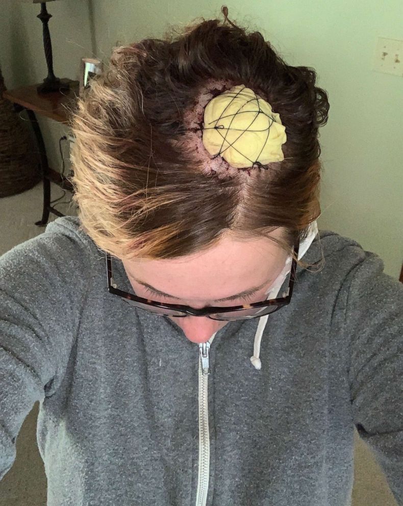 PHOTO: Caitlin Jones, a 30-year-old physician's assistant in Ohio, noticed a suspicious-looking mole on her scalp. Like many patients, she was concerned about going for an in-person appointment.