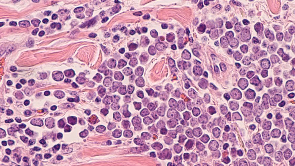 PHOTO: Microscopic image of a Merkel cell carcinoma, a highly aggressive type of skin cancer.