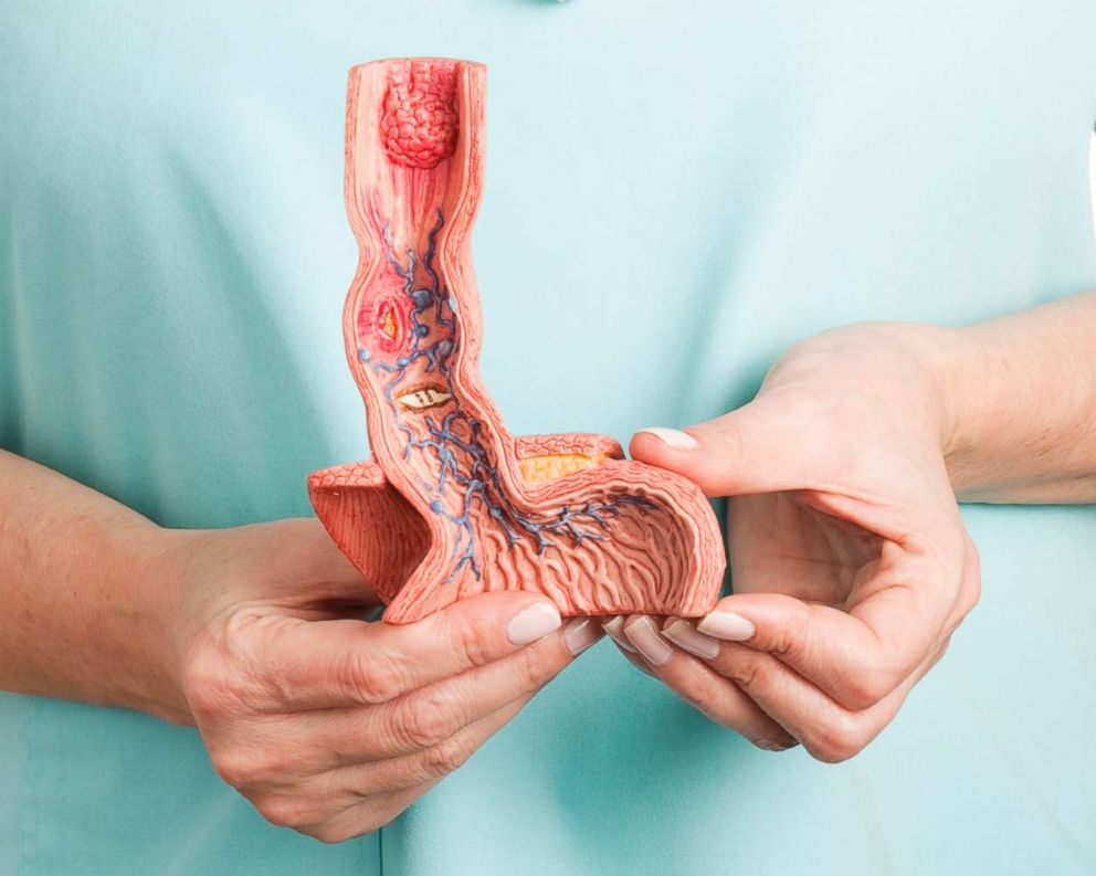 PHOTO: A person holds an anatomical model of a diseased human esophagus.