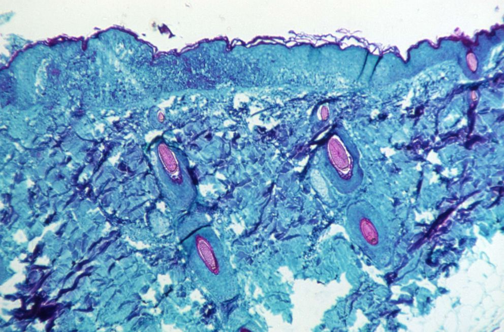 PHOTO: A section of skin tissue, harvested from a lesion on the skin of a monkey, that had been infected with monkeypox virus, is seen at 50X magnification on day four of rash development in 1968.