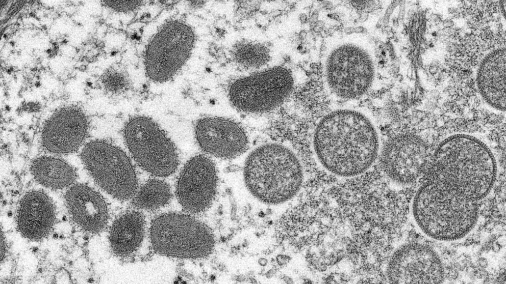 PHOTO : Cette image des Centers for Disease Control and Prevention représente une particule de virus monkeypox obtenue à partir d'un échantillon de peau humaine. 
