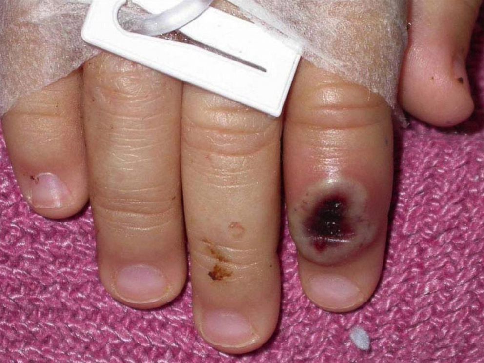PHOTO: A finger infected with monkeypox.