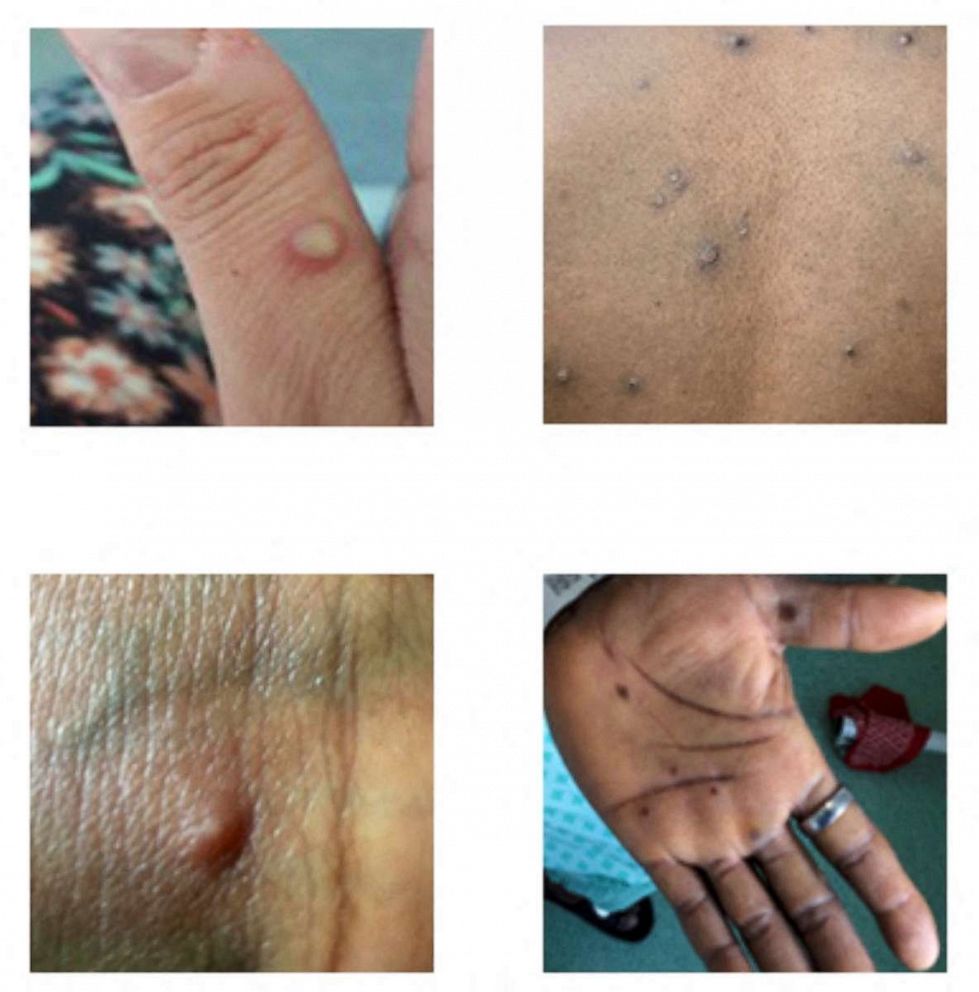 PHOTO: Pictures showing examples of rashes and lesions caused by the monkeypox virus are seen in this handout image obtained from the official Centers for Disease Control and Prevention (CDC) website on July 1, 2022.