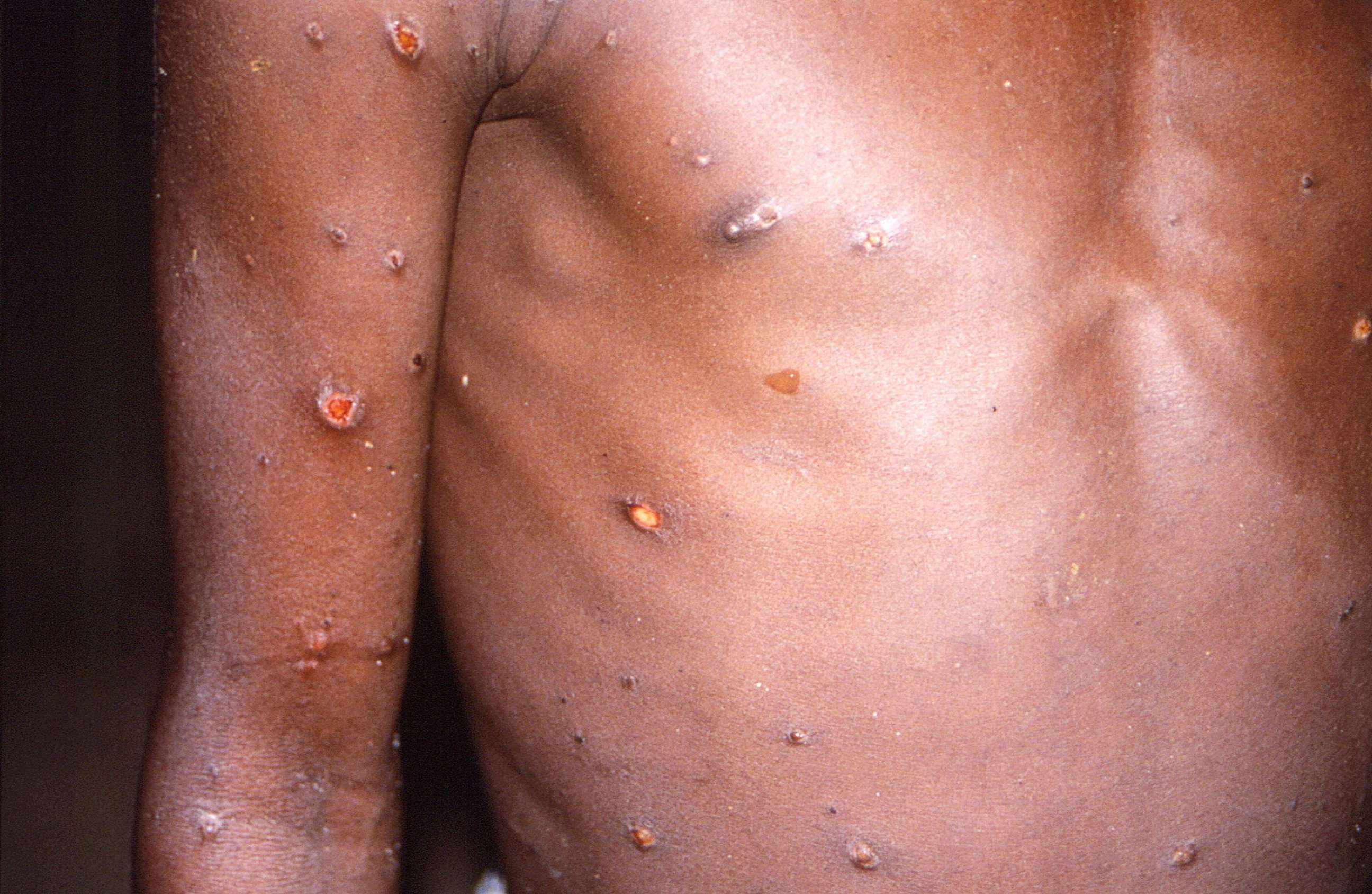 PHOTO: The arms and torso of a patient with skin lesions due to monkeypox, during an investigation into an outbreak in the Democratic Republic of the Congo in 1996-1997.