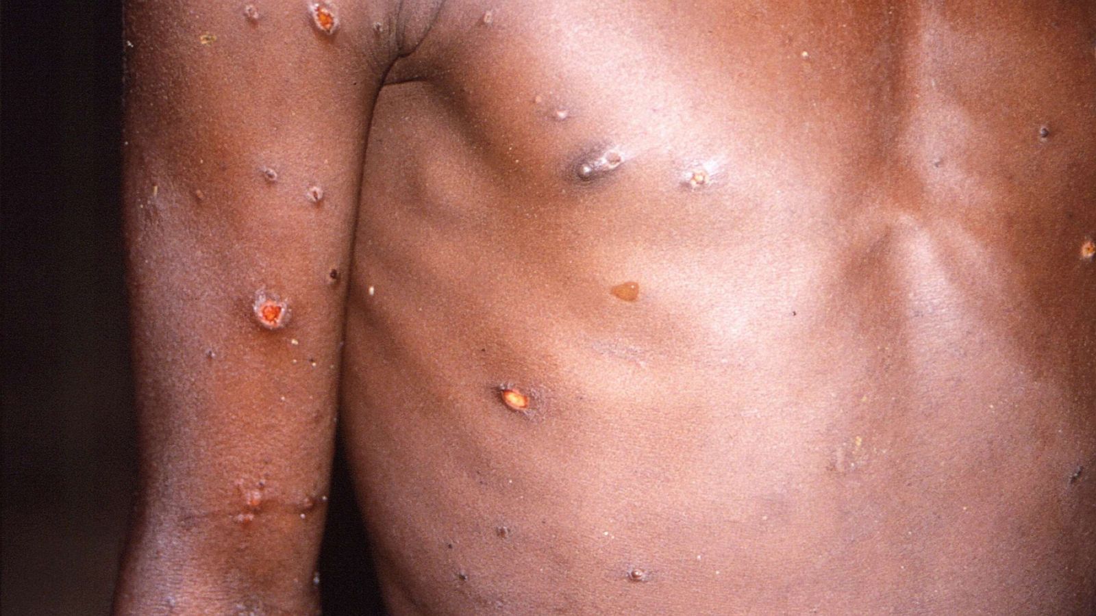 Man Describes Painful, Miserable Monkeypox Symptoms