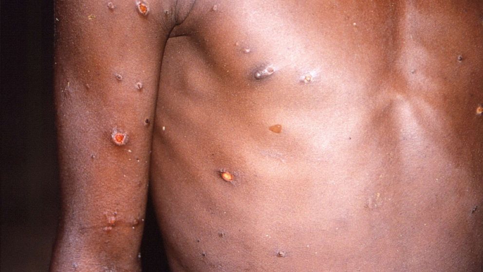 Monkeypox Pictures: How to Identify Symptoms of Monkeypox