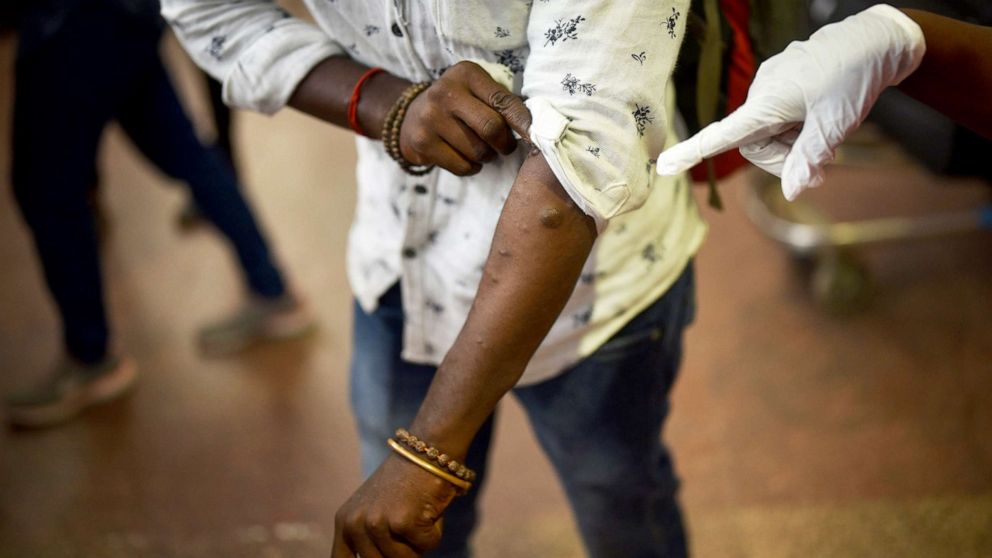 PHOTO: Health workers screen passengers arriving from high-risk countries for symptoms of the Monkeypox virus in Chennai, India, July 16, 2022.