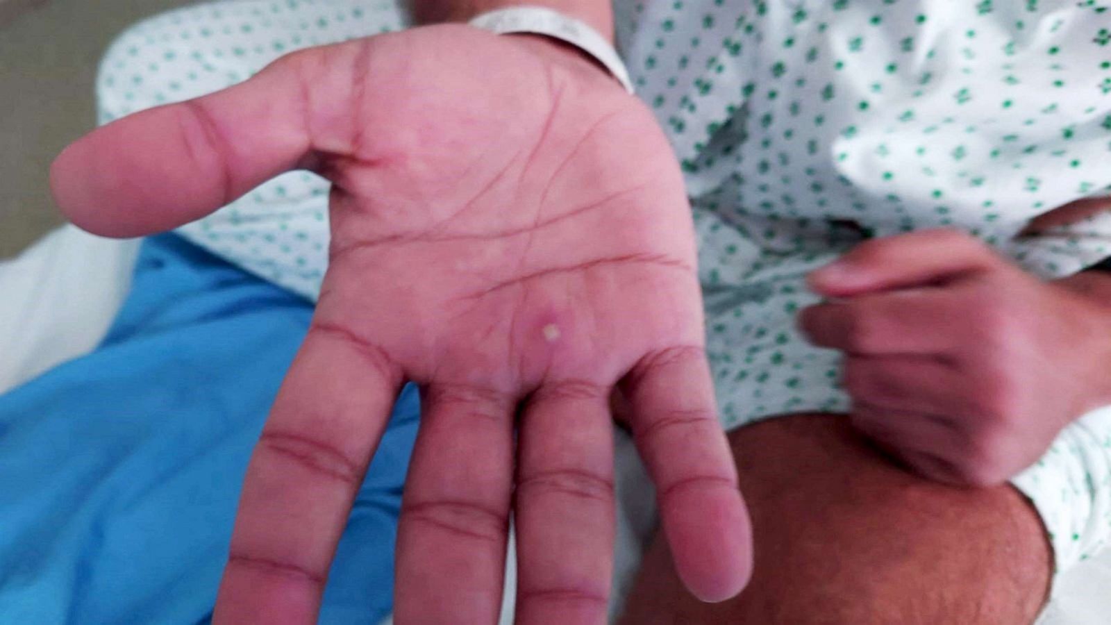 What is monkeypox and its signs and symptoms?