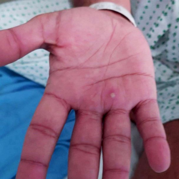 Can monkeypox cause keloid scars?