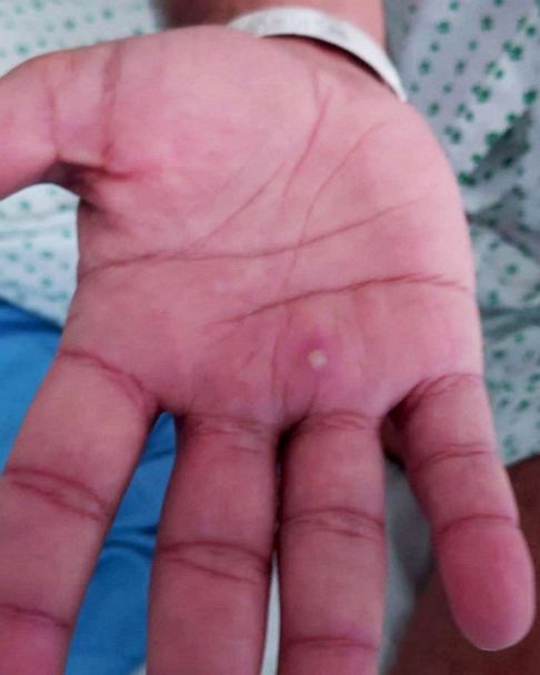 Monkeypox: What Is It, Causes, and More