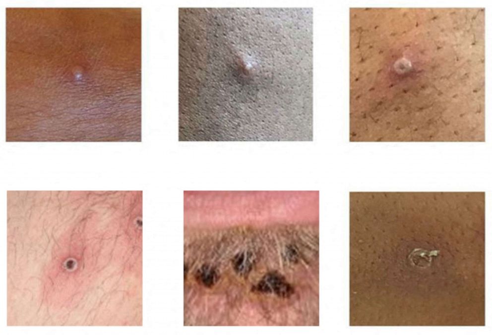 PHOTO: Examples of rashes and lesions caused by the monkeypox virus are seen in this handout image obtained from official Centers for Disease Control and Prevention (CDC) website on July 1, 2022. 