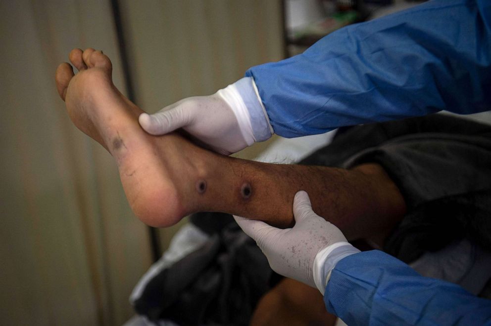 PHOTO: A doctor checks on a patient with sores caused by a monkeypox infection at the Arzobispo Loayza hospital, in Lima, Peru, Aug. 16, 2022.