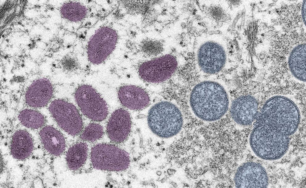 PHOTO: Digitally-colorized electron microscopic image depicts a monkeypox virus particle obtained from a clinical sample associated with a 2003 prairie dog outbreak, published June 6, 2022. 