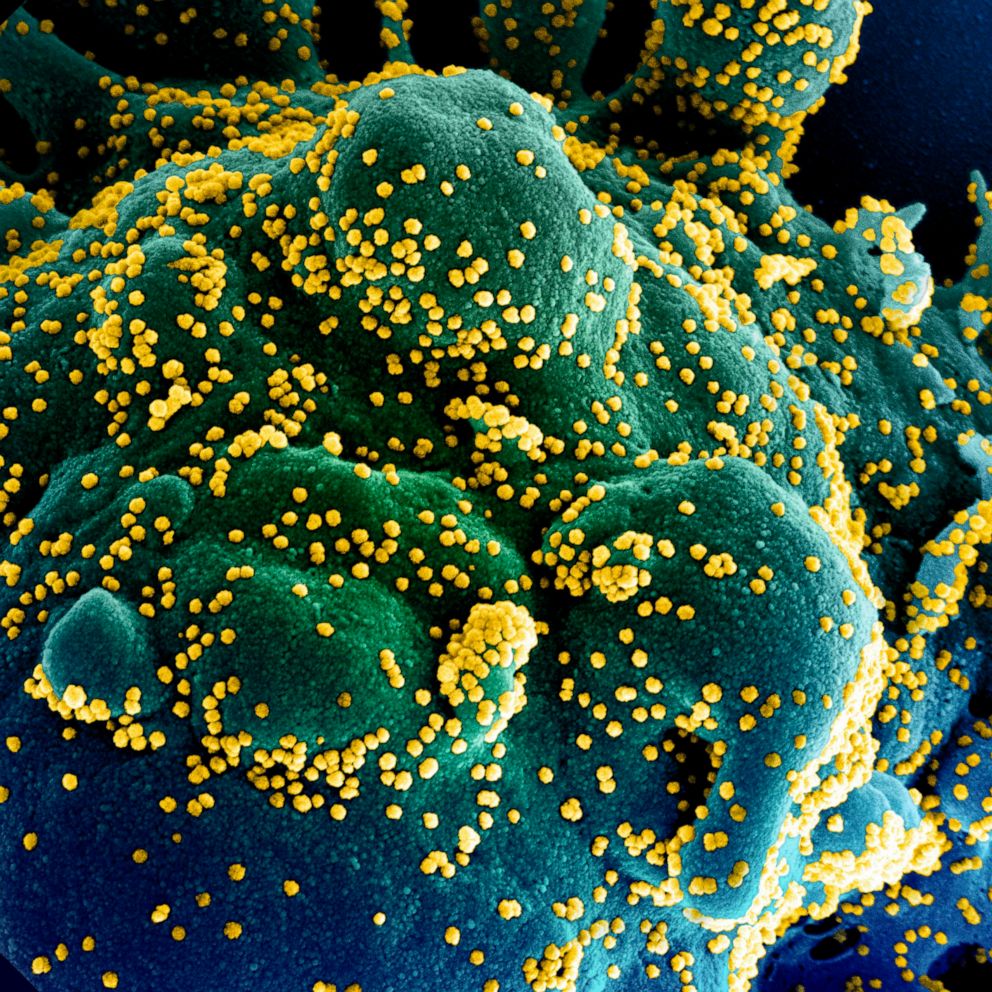 PHOTO: (FILES) In this undated handout image obtained July 15, 2020, courtesy of National Institute of Allergy and Infectious Diseases, shows a colorized scanning electron micrograph of an apoptotic cell heavily infected with SARS-COV-2 virus particles.