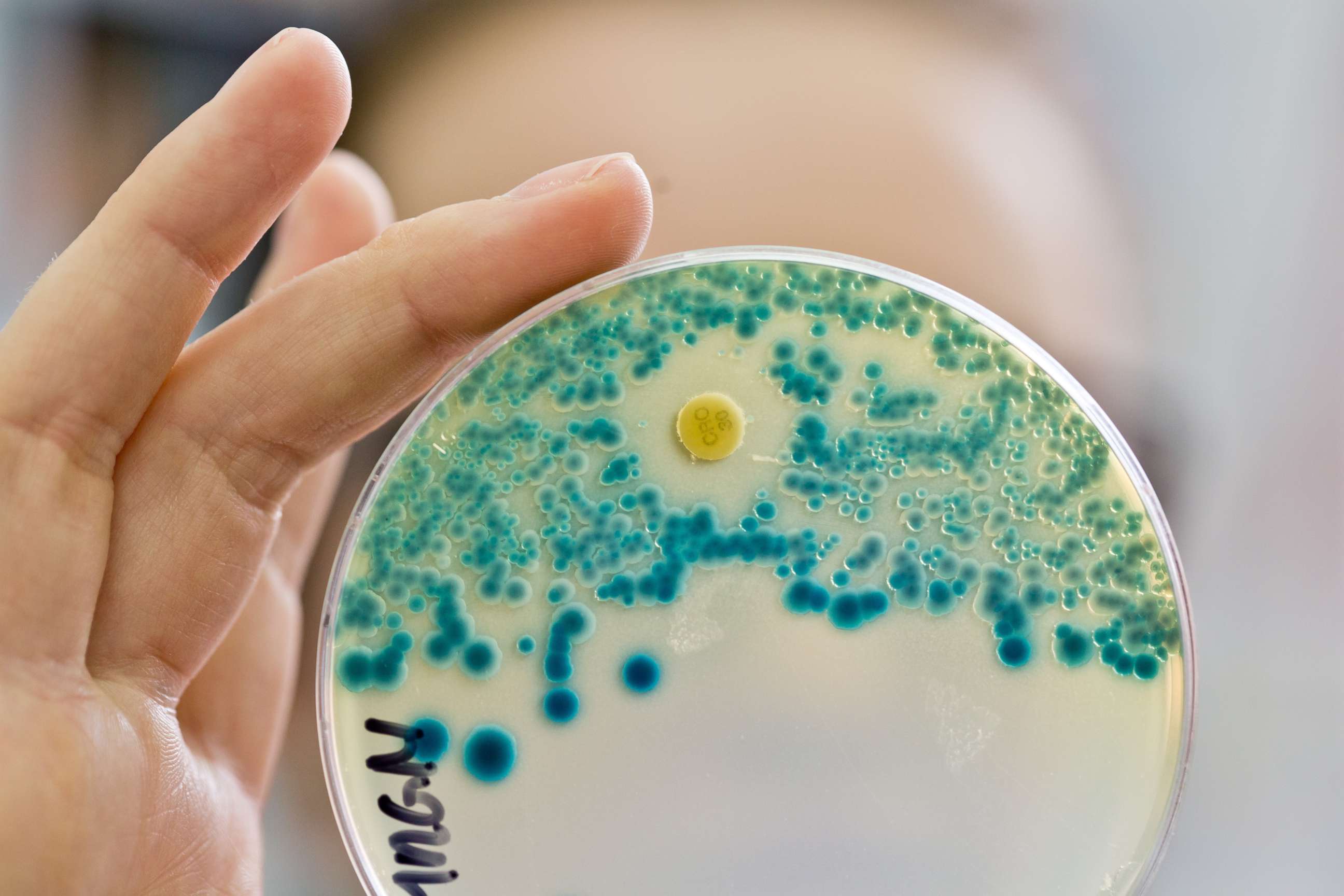 PHOTO: A lab assistant holds up a bacterial culture used to determine drug resistance at a lab in Erlangen, Germany, July 21, 2015.