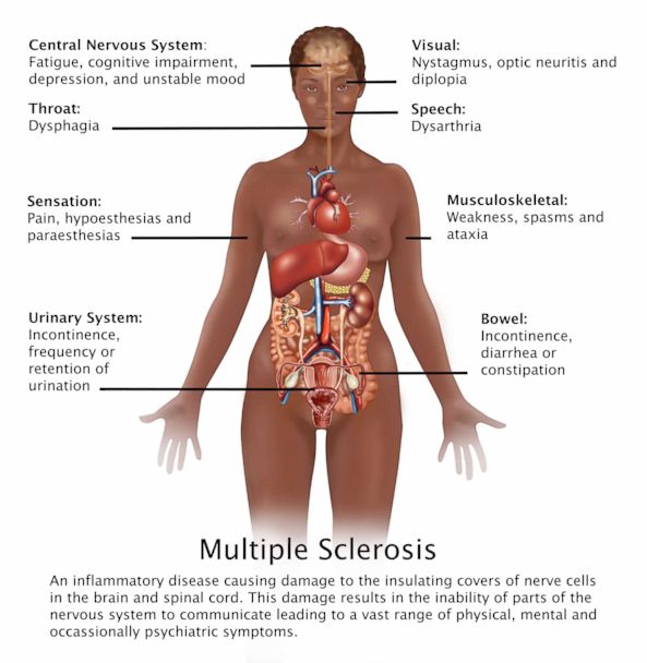 What is multiple sclerosis