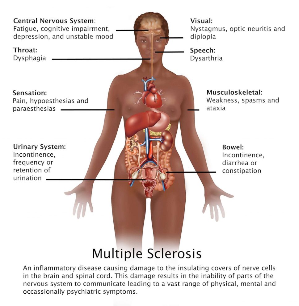 PHOTO: Diagram showing the symptoms of multiple sclerosis and their location in the human body.