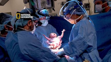 This Baby Basically Delivered Itself During A 'Natural' Cesarean Birth  That's Going Viral