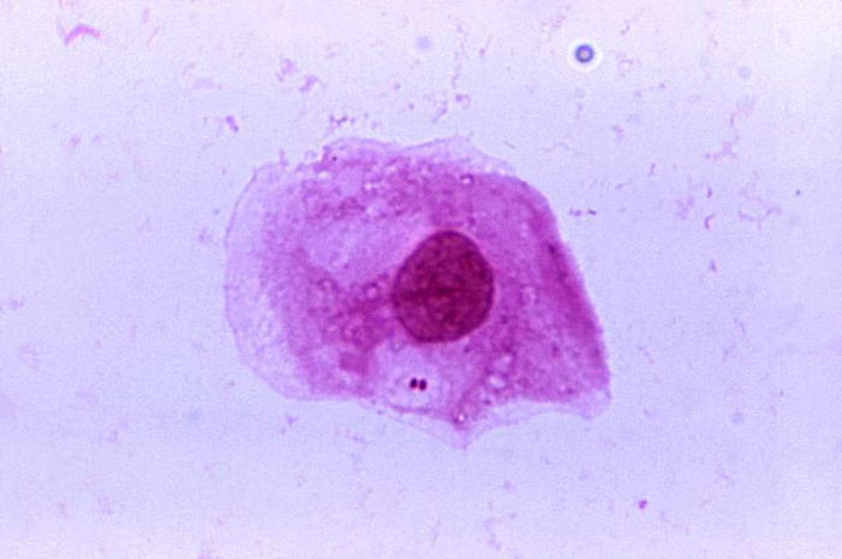 PHOTO: A photomicrograph of Neisseria meningitidis recovered from the urethra of an asymptomatic male.